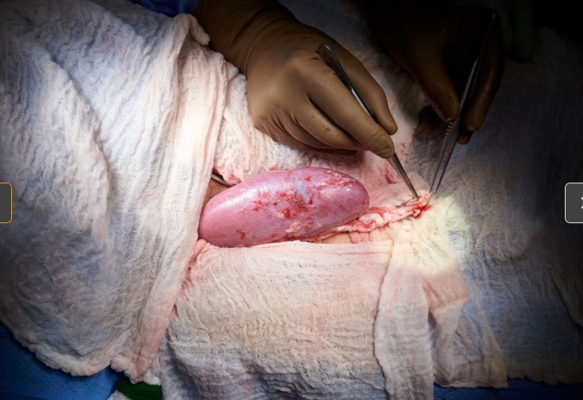 10 20 pig kidney transplant 3