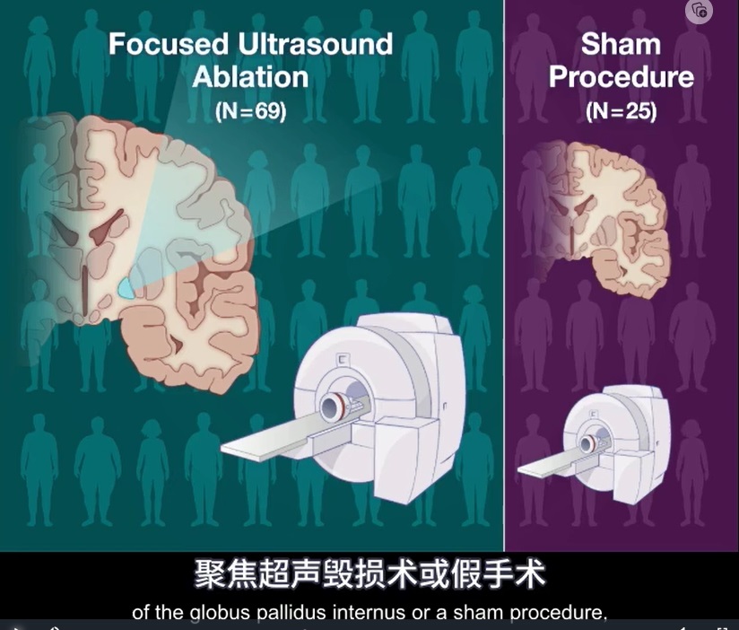 2023 02 26 帕金森治疗 2