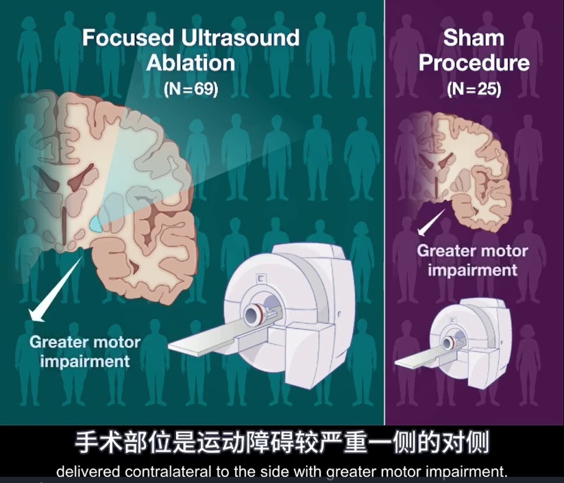 2023 02 26 帕金森治疗 3