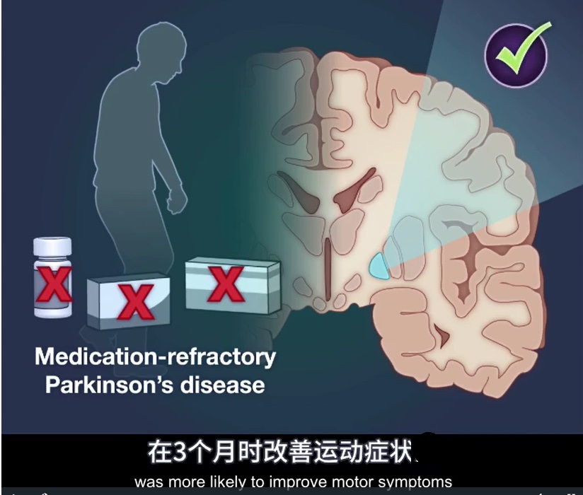2023 02 26 帕金森治疗 7